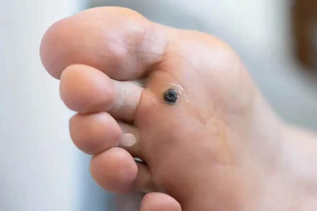 Papiloma Plantar