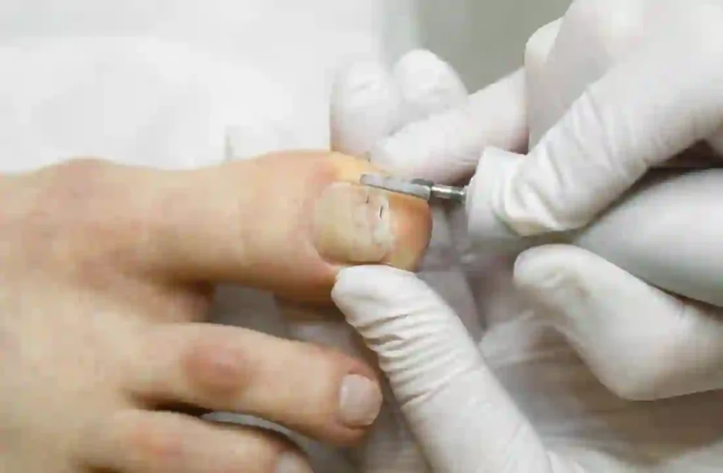 Tratamiento de Podostripe