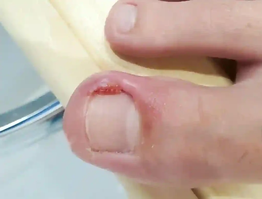 Uña encarnada en dedo del pie.